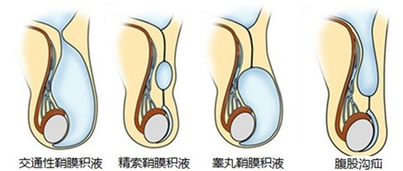 小儿鞘膜积液知多少